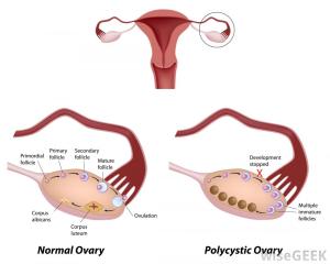 ovary-with-cysts-and-normal-ovary-diagram courtesy of wisegeek
